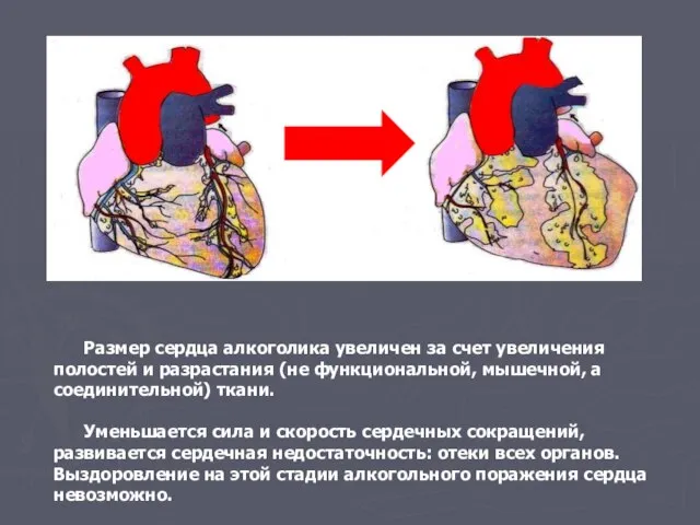 Размер сердца алкоголика увеличен за счет увеличения полостей и разрастания (не функциональной,