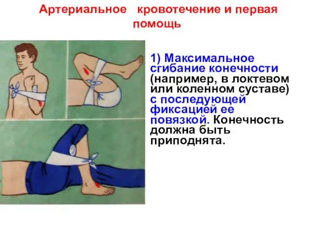 Артериальное кровотечение и первая помощь 1) Максимальное сгибание конечности (например, в локтевом