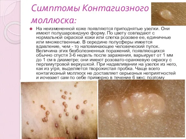 Симптомы Контагиозного моллюска: На неизмененной коже появляются приподнятые узелки. Они имеют полушаровидную