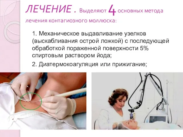ЛЕЧЕНИЕ . Выделяют 4 основных метода лечения контагиозного моллюска: 1. Механическое выдавливание