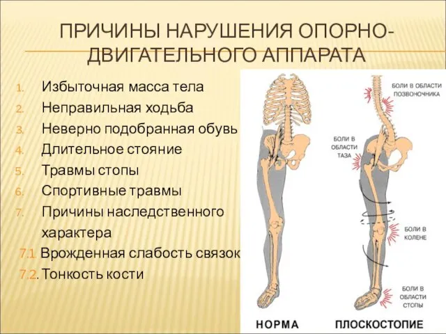 ПРИЧИНЫ НАРУШЕНИЯ ОПОРНО-ДВИГАТЕЛЬНОГО АППАРАТА Избыточная масса тела Неправильная ходьба Неверно подобранная обувь