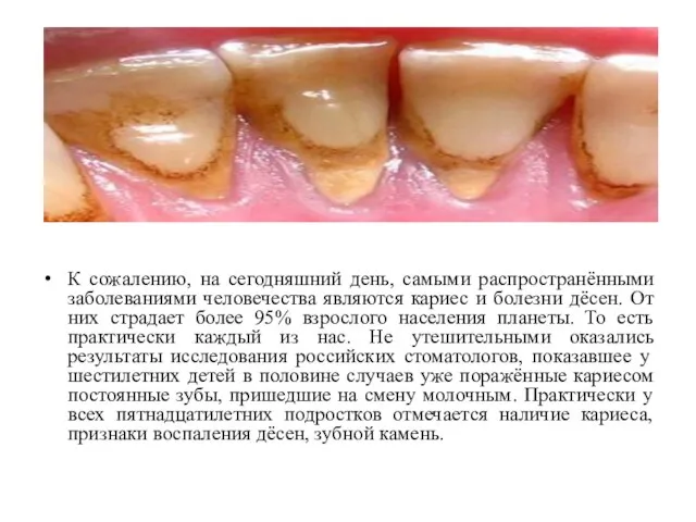 К сожалению, на сегодняшний день, самыми распространёнными заболеваниями человечества являются кариес и