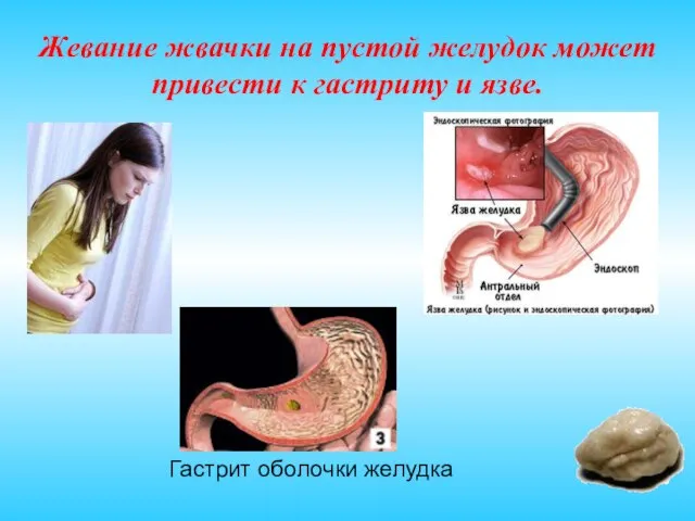 Жевание жвачки на пустой желудок может привести к гастриту и язве. Гастрит оболочки желудка