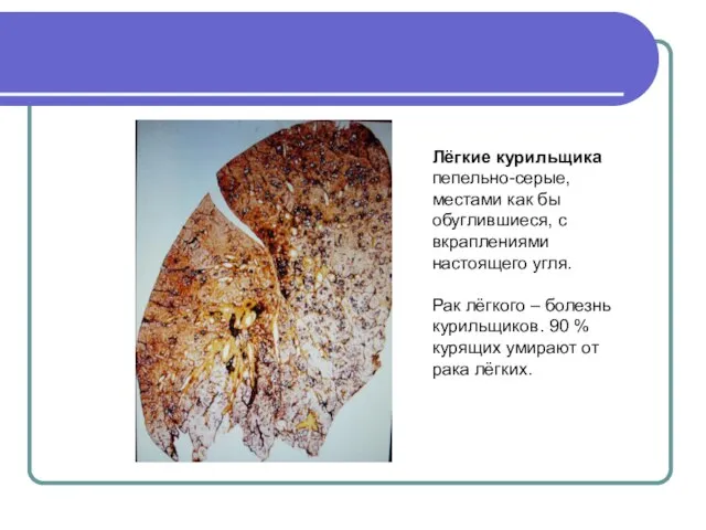 Лёгкие курильщика пепельно-серые, местами как бы обуглившиеся, с вкраплениями настоящего угля. Рак