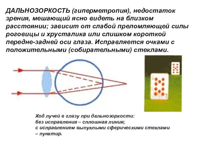 ДАЛЬНОЗОРКОСТЬ (гиперметропия), недостаток зрения, мешающий ясно видеть на близком расстоянии; зависит от