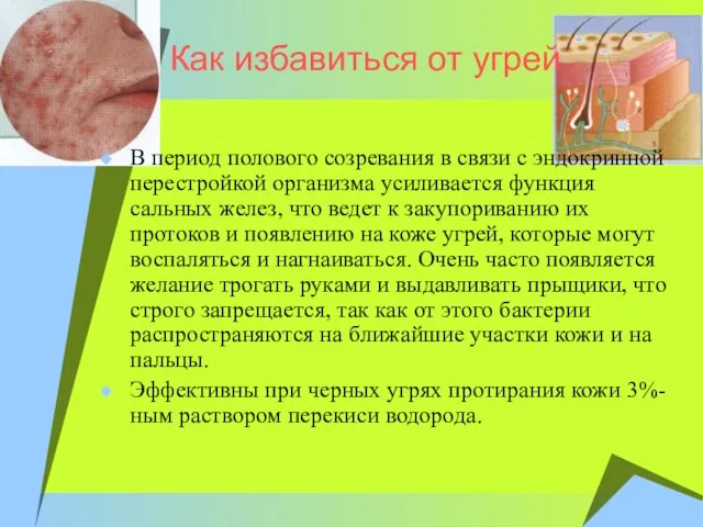 Как избавиться от угрей В период полового созревания в связи с эндокринной