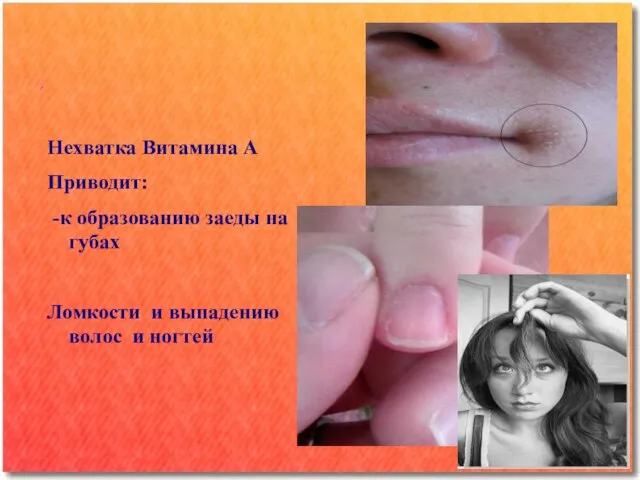 Нехватка Витамина А Приводит: -к образованию заеды на губах Ломкости и выпадению волос и ногтей