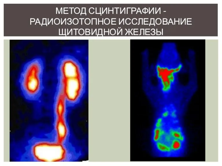 Метод сцинтиграфии - радиоизотопное исследование щитовидной железы