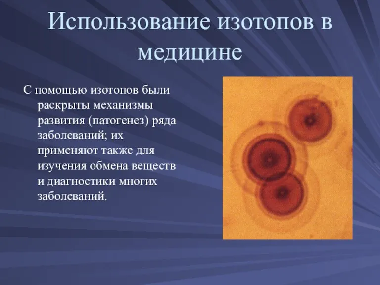 Использование изотопов в медицине С помощью изотопов были раскрыты механизмы развития (патогенез)