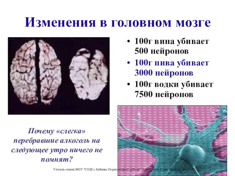 Изменения в головном мозге 100г вина убивает 500 нейронов 100г пива убивает