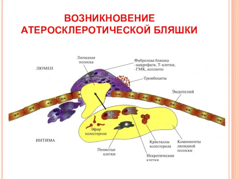 ВОЗНИКНОВЕНИЕ АТЕРОСКЛЕРОТИЧЕСКОЙ БЛЯШКИ