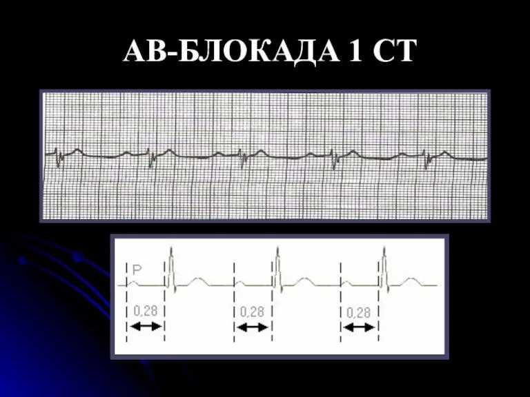 АВ-БЛОКАДА 1 СТ