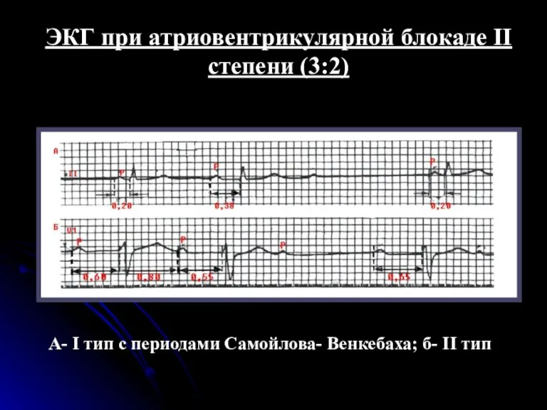 ЭКГ при атриовентрикулярной блокаде II степени (3:2) А- I тип с периодами