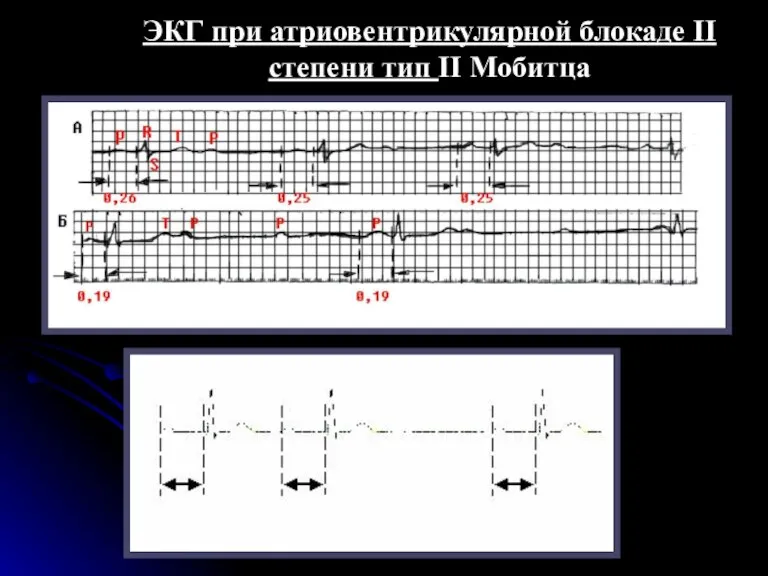 ЭКГ при атриовентрикулярной блокаде II степени тип II Мобитца