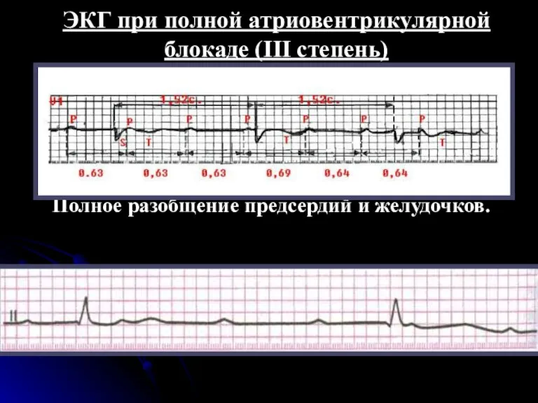 ЭКГ при полной атриовентрикулярной блокаде (III степень) Полное разобщение предсердий и желудочков.