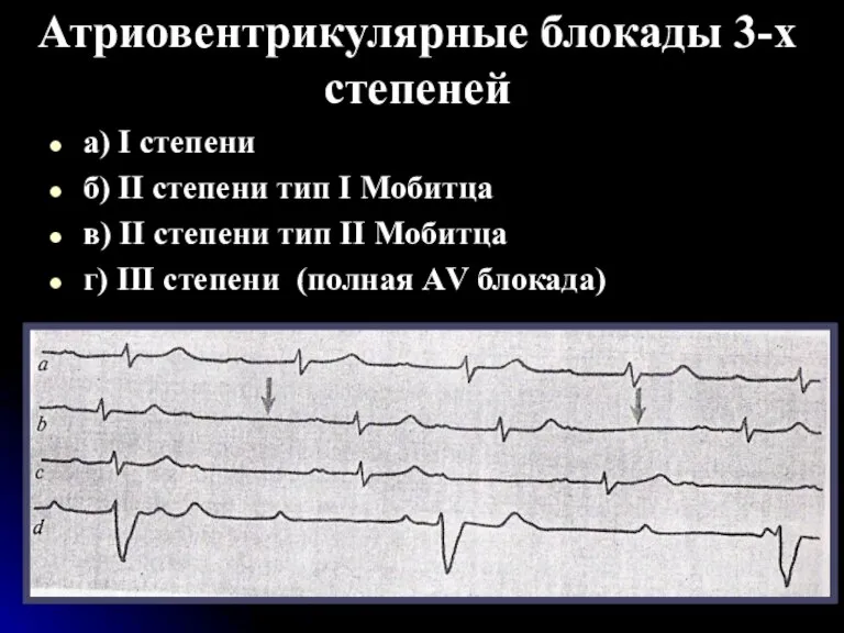 Атриовентрикулярные блокады 3-х степеней а) I степени б) II степени тип I