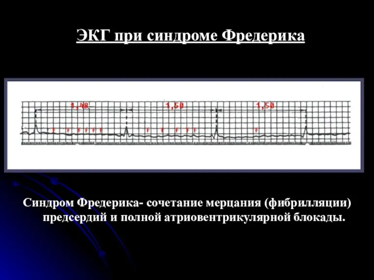 ЭКГ при синдроме Фредерика Синдром Фредерика- сочетание мерцания (фибрилляции) предсердий и полной атриовентрикулярной блокады.