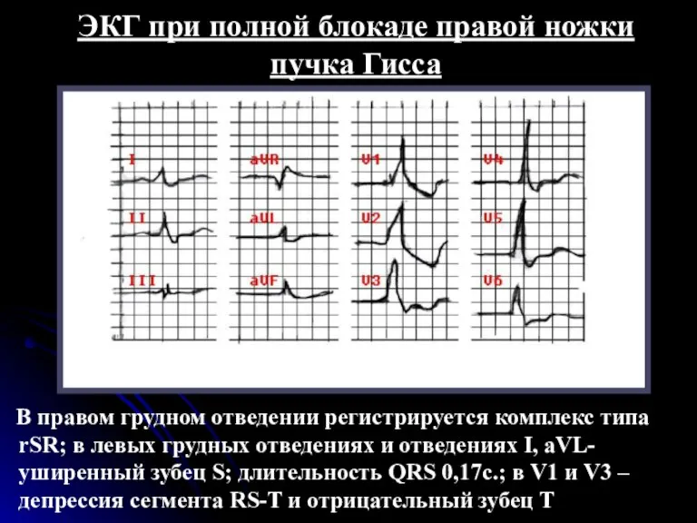 ЭКГ при полной блокаде правой ножки пучка Гисса В правом грудном отведении