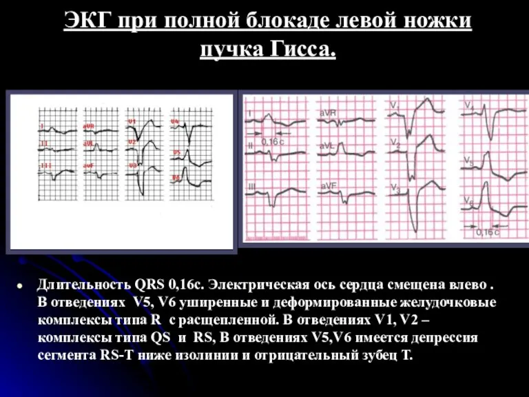 ЭКГ при полной блокаде левой ножки пучка Гисса. Длительность QRS 0,16с. Электрическая