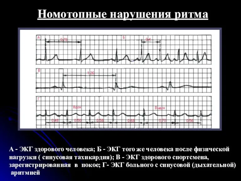 Номотопные нарушения ритма А - ЭКГ здорового человека; Б - ЭКГ того