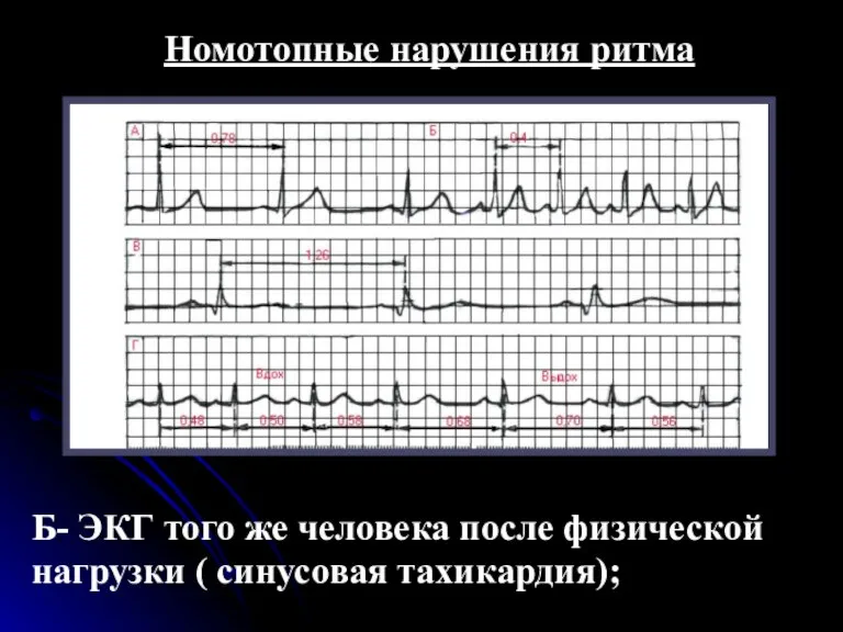 Номотопные нарушения ритма Б- ЭКГ того же человека после физической нагрузки ( синусовая тахикардия);