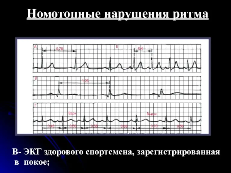 Номотопные нарушения ритма В- ЭКГ здорового спортсмена, зарегистрированная в покое;