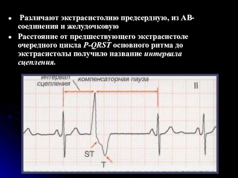 Различают экстрасистолию предсердную, из АВ-соединения и желудочковую Расстояние от предшествующего экстрасистоле очередного