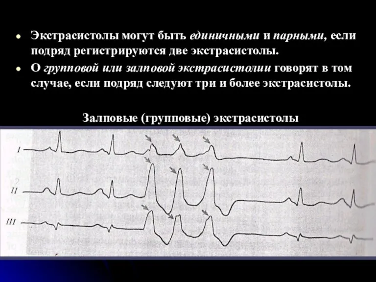 Экстрасистолы могут быть единичными и парными, если подряд регистрируются две экстрасистолы. О