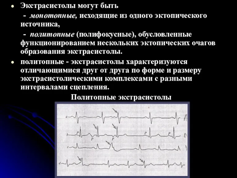 Экстрасистолы могут быть - монотопные, исходящие из одного эктопического источника, - политопные