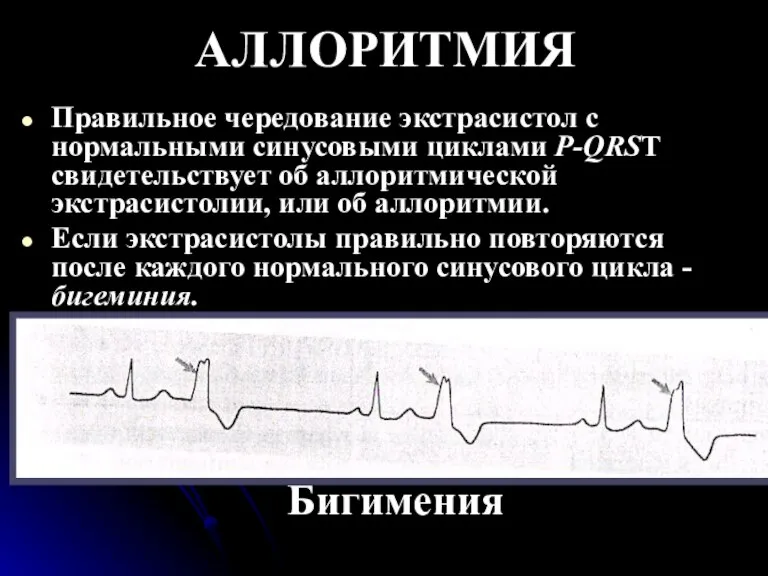 АЛЛОРИТМИЯ Правильное чередование экстрасистол с нормальными синусовыми циклами Р-QRSТ свидетельствует об аллоритмической