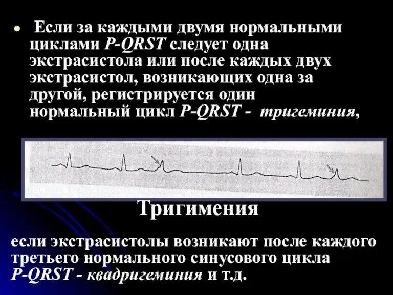 Если за каждыми двумя нормальными циклами Р-QRST следует одна экстрасистола или после