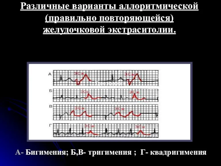 Различные варианты аллоритмической (правильно повторяющейся) желудочковой экстраситолии. А- Бигимения; Б,В- тригимения ; Г- квадригимения Тригимения