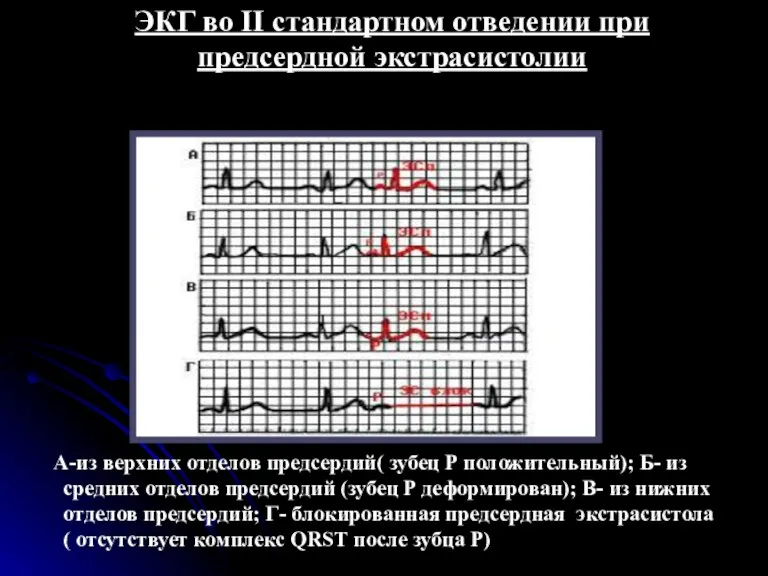 ЭКГ во II стандартном отведении при предсердной экстрасистолии А-из верхних отделов предсердий(