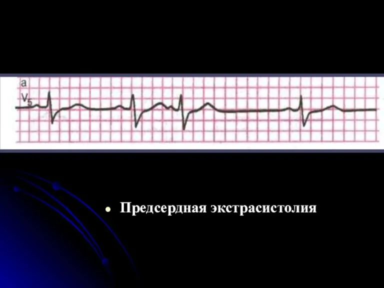 Предсердная экстрасистолия