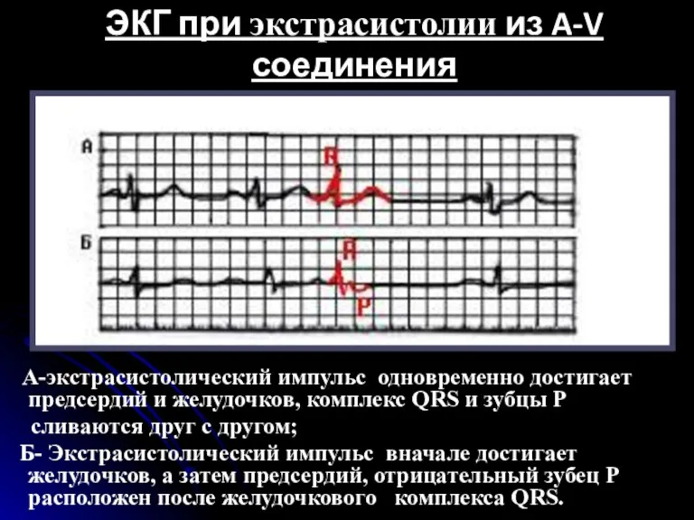 ЭКГ при экстрасистолии из A-V соединения А-экстрасистолический импульс одновременно достигает предсердий и