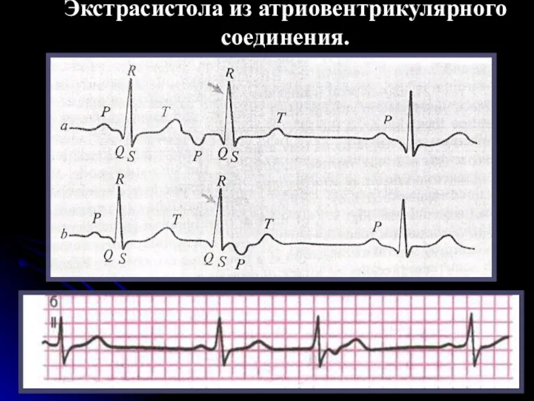 Экстрасистола из атриовентрикулярного соединения.