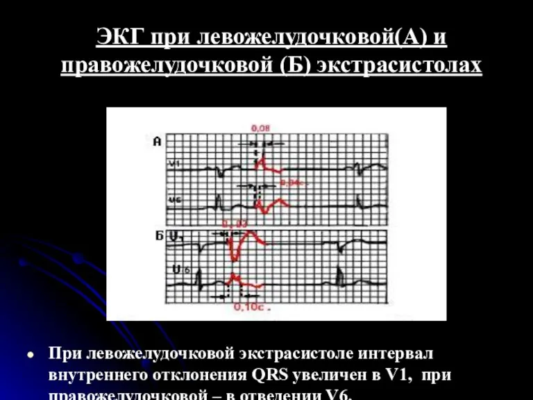 ЭКГ при левожелудочковой(А) и правожелудочковой (Б) экстрасистолах При левожелудочковой экстрасистоле интервал внутреннего