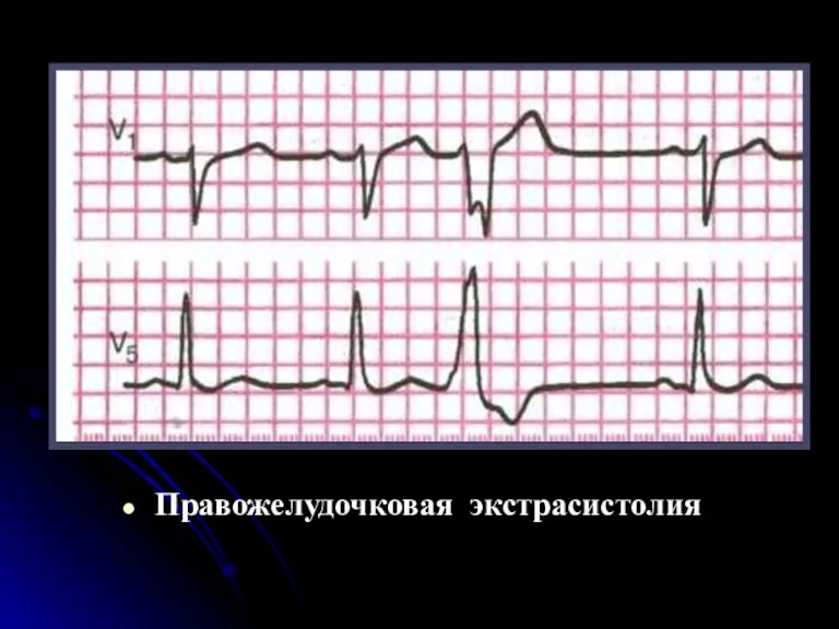 Правожелудочковая экстрасистолия