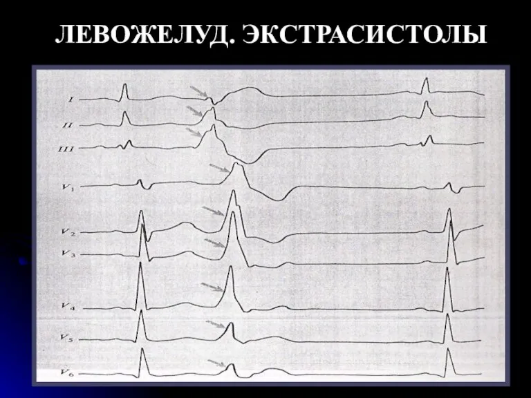 ЛЕВОЖЕЛУД. ЭКСТРАСИСТОЛЫ