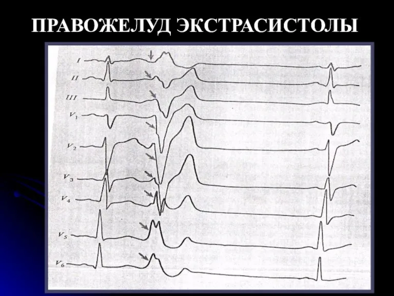 ПРАВОЖЕЛУД ЭКСТРАСИСТОЛЫ