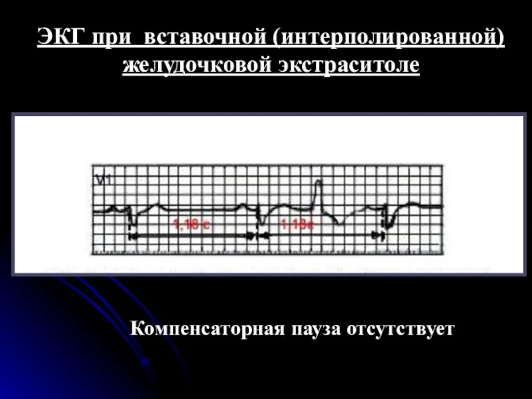 ЭКГ при вставочной (интерполированной) желудочковой экстраситоле Компенсаторная пауза отсутствует