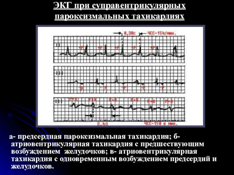 ЭКГ при суправентрикулярных пароксизмальных тахикардиях а- предсердная пароксизмальная тахикардия; б- атриовентрикулярная тахикардия