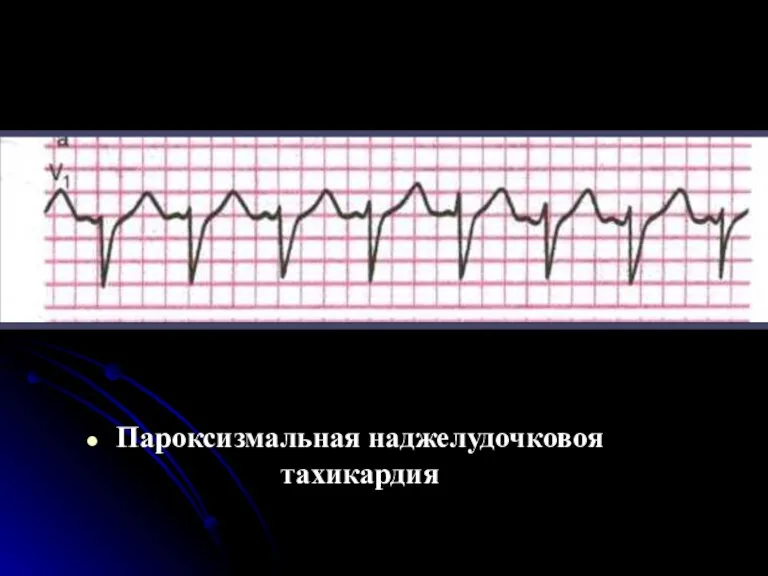 Пароксизмальная наджелудочковоя тахикардия