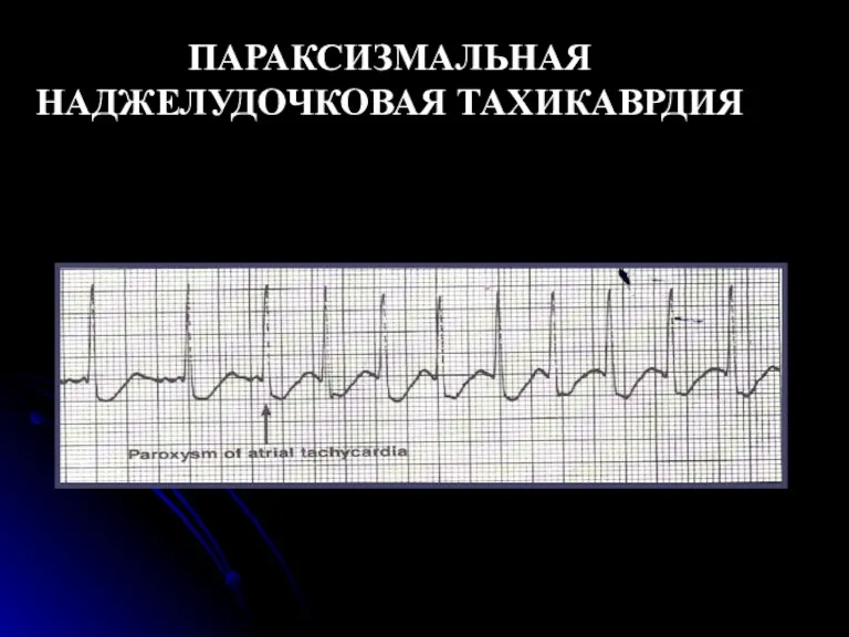 ПАРАКСИЗМАЛЬНАЯ НАДЖЕЛУДОЧКОВАЯ ТАХИКАВРДИЯ