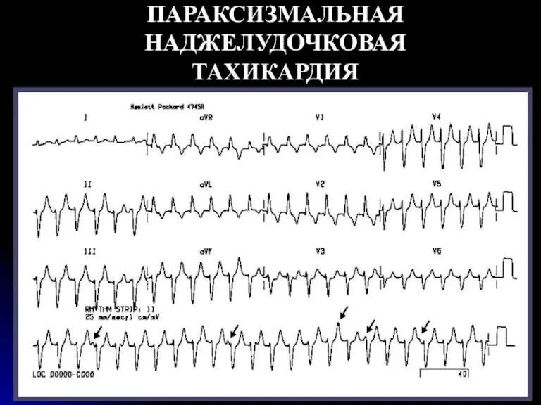 ПАРАКСИЗМАЛЬНАЯ НАДЖЕЛУДОЧКОВАЯ ТАХИКАРДИЯ