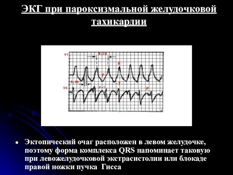 ЭКГ при пароксизмальной желудочковой тахикардии Эктопический очаг расположен в левом желудочке, поэтому