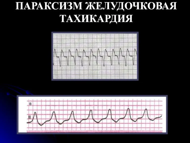 ПАРАКСИЗМ ЖЕЛУДОЧКОВАЯ ТАХИКАРДИЯ