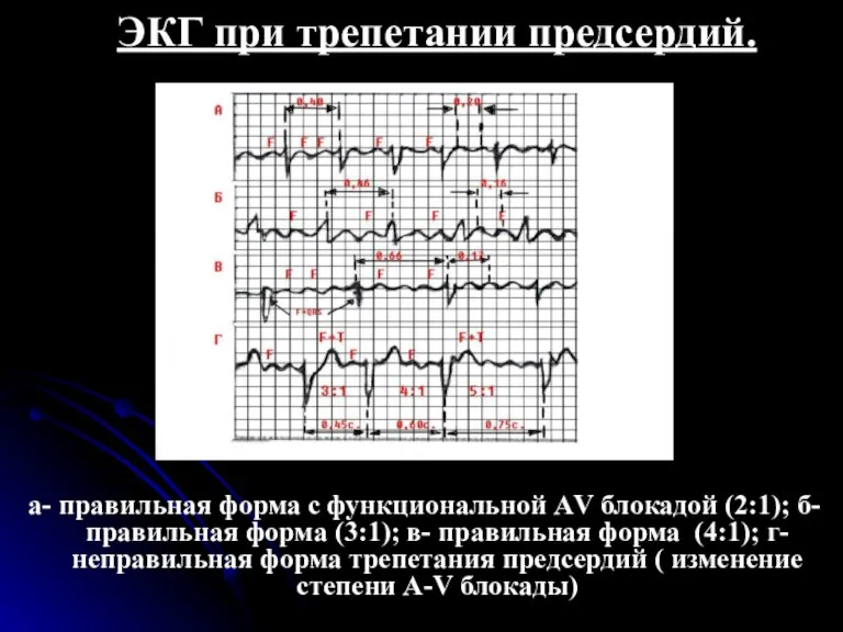 ЭКГ при трепетании предсердий. а- правильная форма с функциональной АV блокадой (2:1);