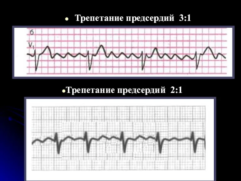 Трепетание предсердий 3:1 Трепетание предсердий 2:1