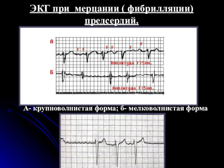 ЭКГ при мерцании ( фибрилляции) предсердий. А- крупноволнистая форма; б- мелковолнистая форма